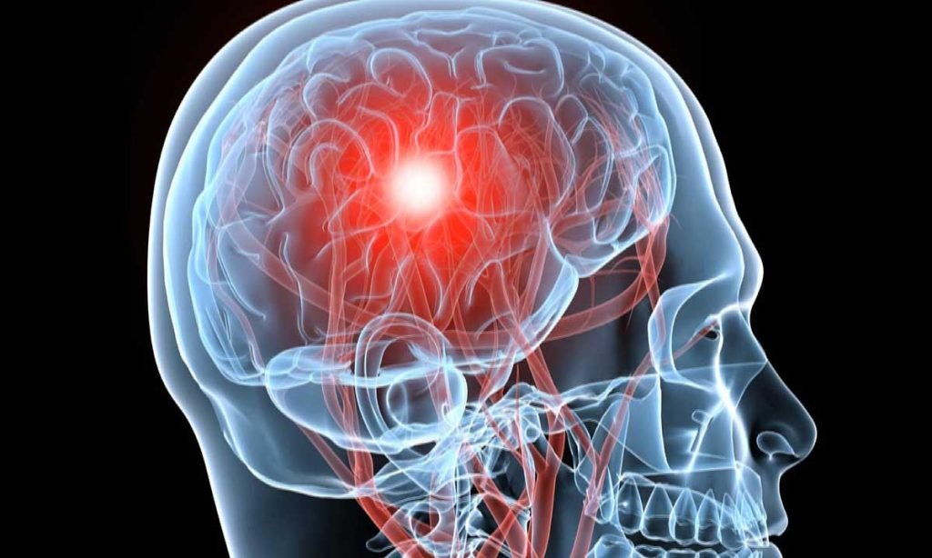 Types of Acquired Brain Injuries